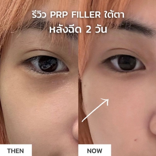 Review PRP Filler